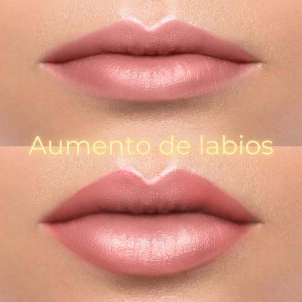 Aumento de Labios en Xàtiva | Volumen y Definición Natural